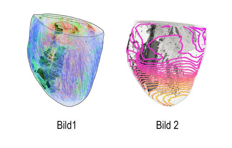 Studie der Uni Freiburg erklärt plötzlichen Herztod neu